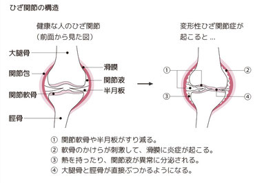 変形性関節症の検査と治療