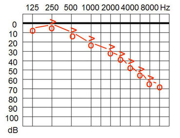 Audiogramm eines mittelgradig Schwerhörenden