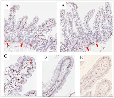 Bild einer mikroskopierten Biopsie aus dem Dünndarm von Patienten mit Nickelallergie und NZGS. Dargestellt ist u.a. eine auffallende Verteilung der T-Lymphozyten in den unteren Schichten der Darmschleimhaut.