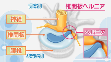 慢性腰痛から腰椎ヘルニアへの画像