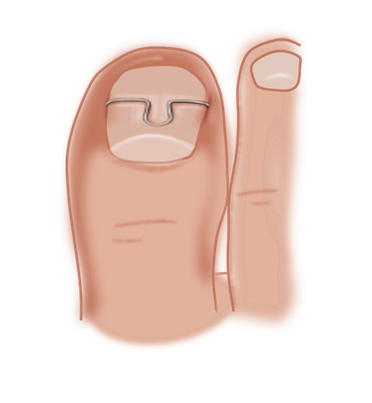 Nagelspange eingewachsener Zehennagel