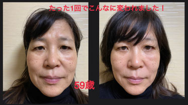 小顔美人シンメトリー・左(ビフォー)右(アフター)の写真