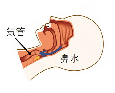 就寝時に鼻水は、ゆっくり喉に流れ気管の手前まで流れる