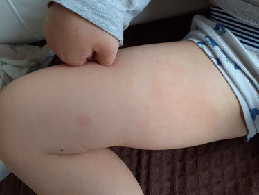 peau seche ou eczema plaque rouge face interne d une cuisse