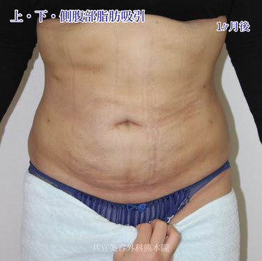  上腹部・下腹部・側腹部脂肪吸引術1か月後（正面）