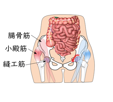 股関節の痛み　大腿骨頭