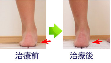 有痛性外頸骨 ゆうつうせいがいけいこつ 足の痛みの特化ラボ