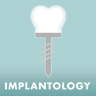 Implantologie Die Zahnkünstler Hannover 