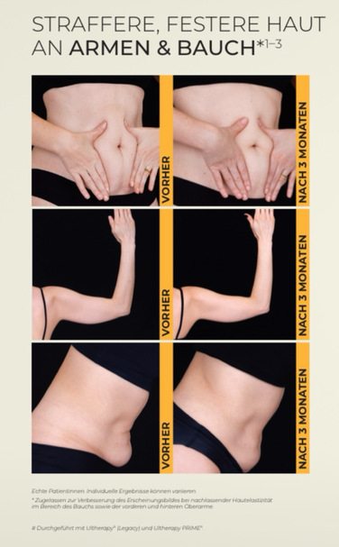 Ultherapy Körper