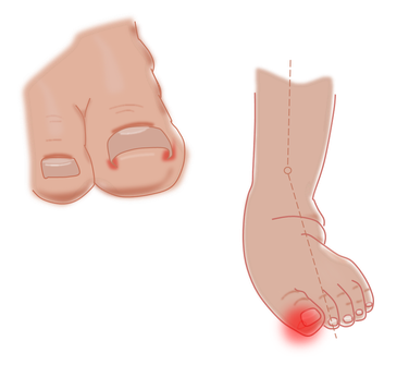 eingewachsener Nagel - genetisch oder Fehlstellung