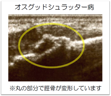 オスグッド　松戸市　新松戸　ポプラはりきゅう整骨院