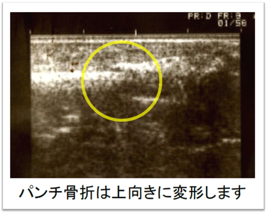 松戸市　新松戸　ポプラはりきゅう整骨院　松戸　南流山　流山市　柏市　交通事故　腰痛　美容鍼　小顔矯正　耳つぼダイエット　中手骨の骨折　パンチ骨折