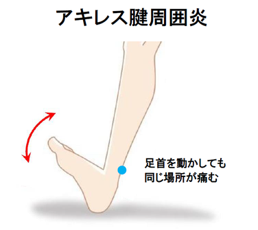 アキレス腱炎　アキレス腱周囲炎　松戸市　新松戸　ポプラはりきゅう整骨院