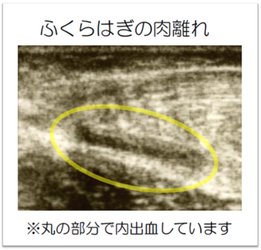 肉離れ　松戸市　新松戸　ポプラはりきゅう整骨院