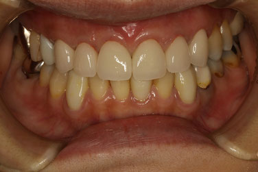 差し歯の再治療
