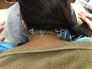 小牧 鍼灸 はり 治療 腰痛 坐骨神経痛 自律神経 乱れ 頭痛 めまい 吐き気 過敏性腸症候群 下痢 便秘 食欲不振