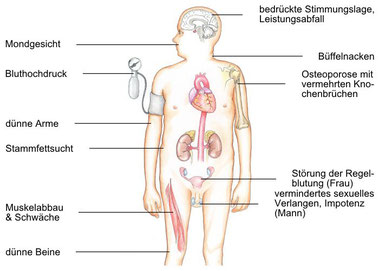 Merkmale des Cushing-Syndroms (www.eesom.com