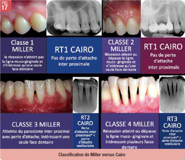 classification des récessions gingivales