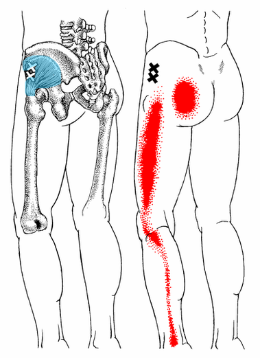 左側：青色が原因の小殿筋　右側：赤色が痛み