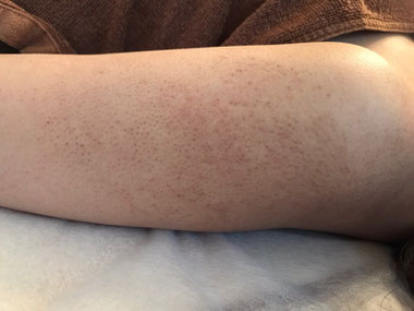 毛孔性苔癬・二の腕ぶつぶつ　写真　サロンドノム