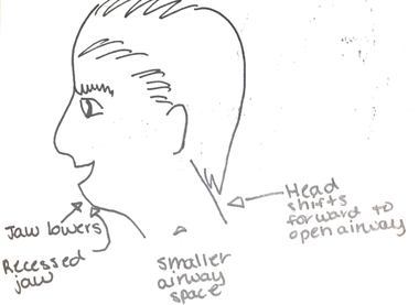 mouth breathing