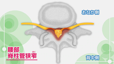 慢性腰痛から脊柱管狭窄症への画像