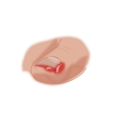 eingewachsener Zehennagel