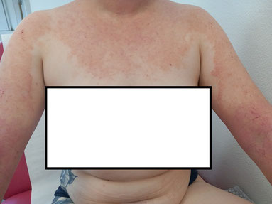 atteinte du cou et du decollete par l eczema