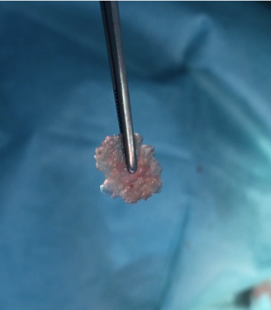 Cartilage graft with PRF