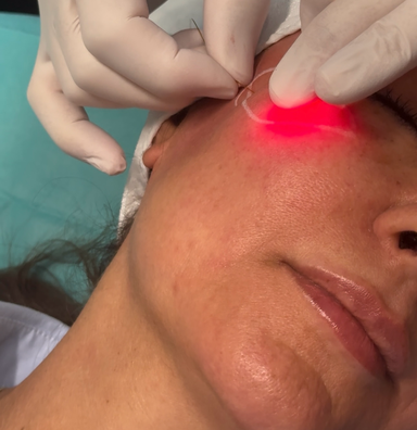 Endolift Malar Bags: Sehr häufig behandeln wir Schwellungen seitlich unter den Augen, Malar Bags mit Endolift