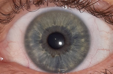 Neurogen-sensible Iris lymphatische Konstitution