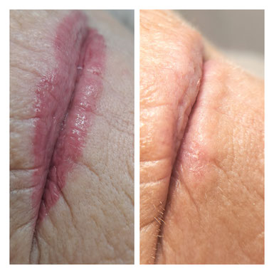 "pmu voor lipblush behandeling en genezen resultaat Uitgeest"