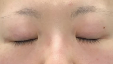 目頭切開症例の画像