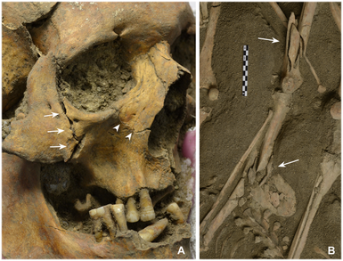 (A) L'individu le plus âgé (entre 40 et 50 ans) avait des fractures à la pommette et à la mâchoire, (B) Cette fracture au fémur d'un autre individu fut probablement due à une chute causée par une arme à feu