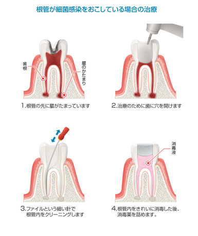 八戸市の歯医者　くぼた歯科　神経　根　痛くない　おすすめ