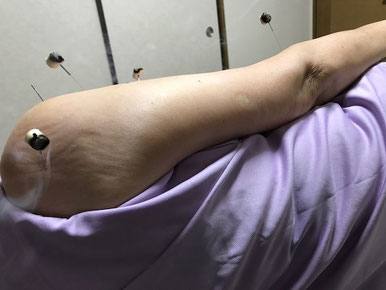 小牧 鍼灸 腰痛 自律神経