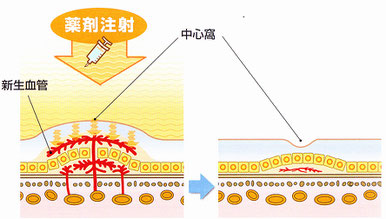 加齢黄斑変性症の治療法。抗ＶＧＥＦ療法（ルセンティス）