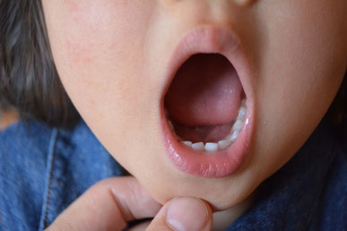 子どもの虫歯予防