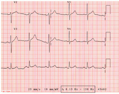 Electrocardiogramme de votre professeur