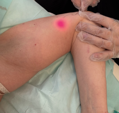 Endolift Behandlung unebene Haut Arminnenseite