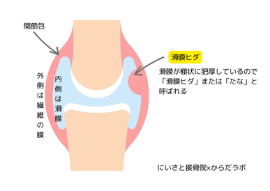 ひざの関節の内側にある滑膜が厚く「ヒダ」状になる事がある