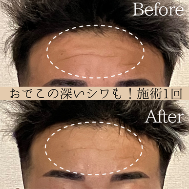 小顔 骨格矯正 ビフォーアフター