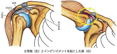 インピンジメント症候群 アスリート鍼灸整骨院