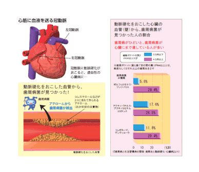 歯周病と動脈硬化
