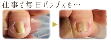 ニコ舎 巻き爪のばし お客様事例