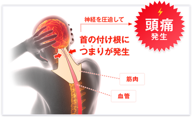 首のつけ根につまりが発生すると神経を圧迫して頭痛が発生する