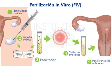 Fecundación in vitro