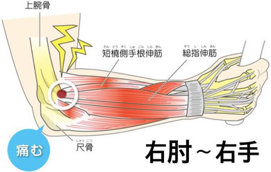 肘の障害イラスト