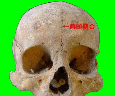 前頭縫合:江戸時代人骨