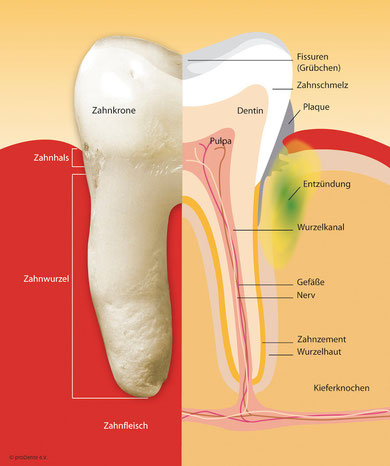 Eine unbehandelte Parodontitis kann zu Zahnverlust führen.
